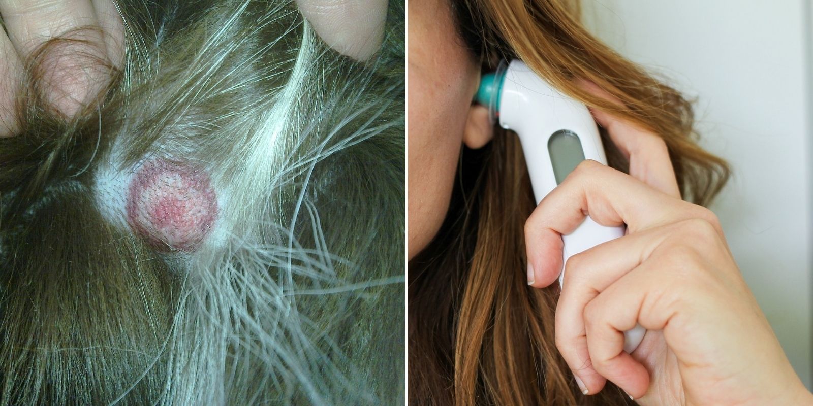 symptômes maladie lyme